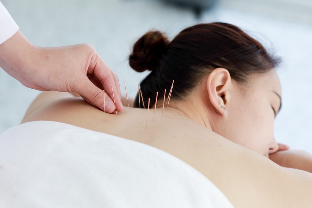 Bienfaits de l’acupuncture et grossesse : tout ce que vous devez savoir